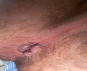Why does my Anus look like this? I suppose it could be hemorrhoids but this consistency of my stool has been abnormal too. I was treated for rectal Gonorrhea in February and haven’t pooped normally since!! (m 21, GRAPHIC) from aunty anus stool pissingillage ki bhabhi bf com